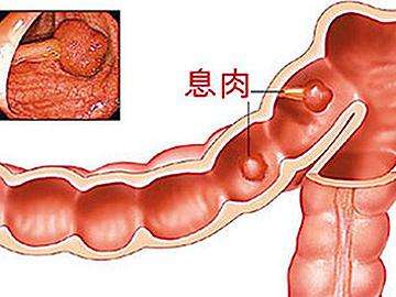 肠息肉到厦门哪家医院治疗