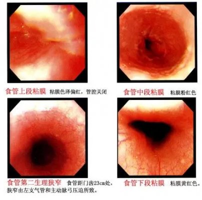 厦门做胃镜前要注意什么